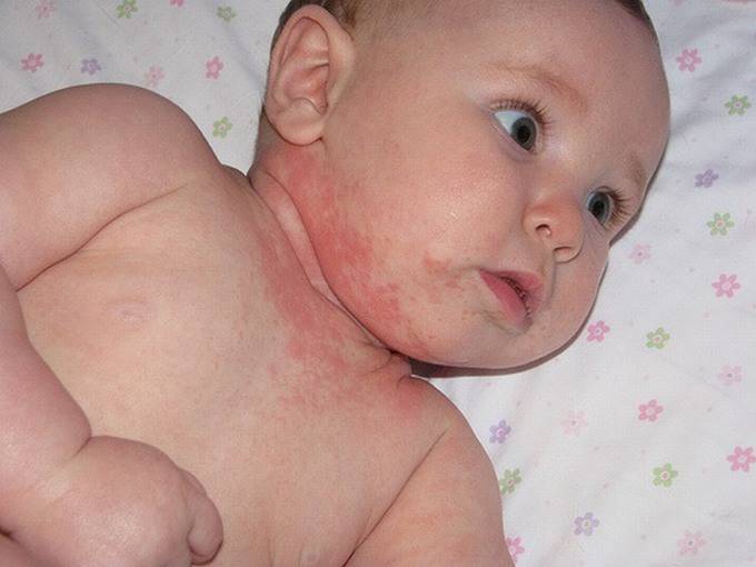 Trẻ bị nổi mẩn đỏ từng mảng trên da có thể là biểu hiện của bệnh viêm da dị ứng