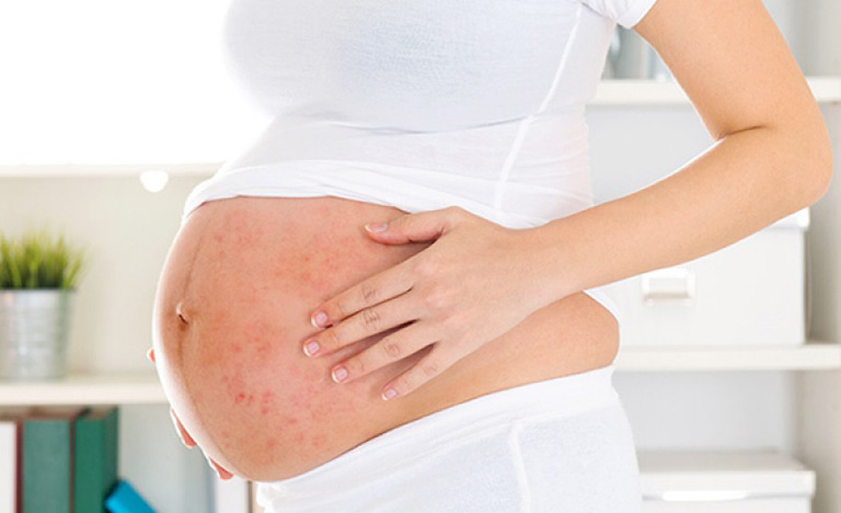 Các thông tin cần biết về bệnh viêm da cơ địa khi mang thai