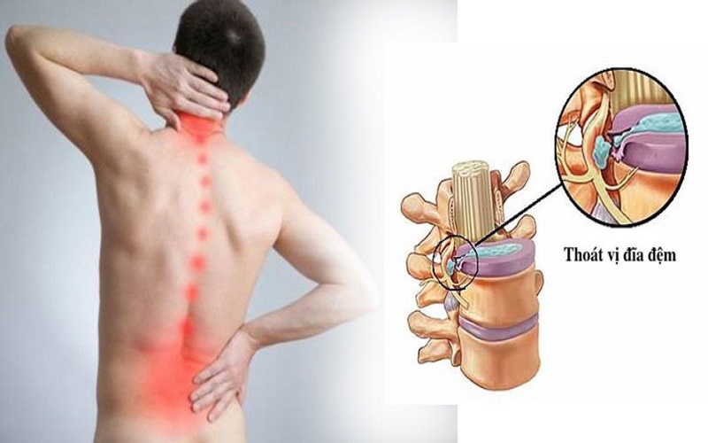 Tại sao thoát vị đĩa đệm gây đau lưng cho người bệnh?