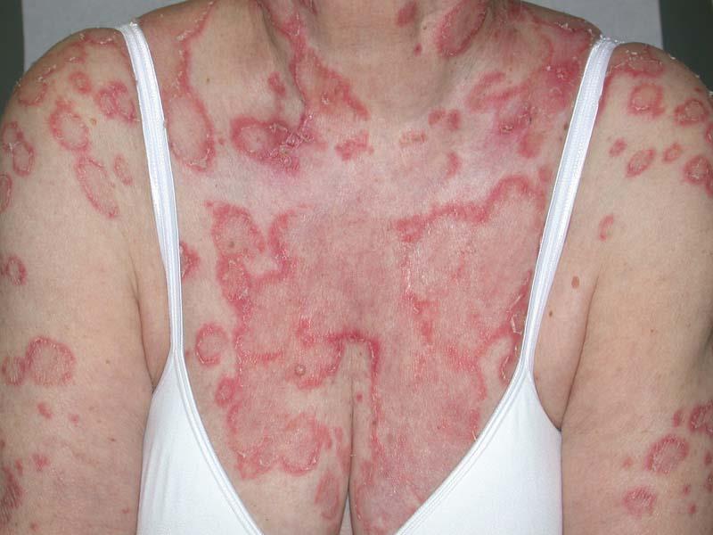 lupus ban đỏ dạng đĩa có nguy hiểm