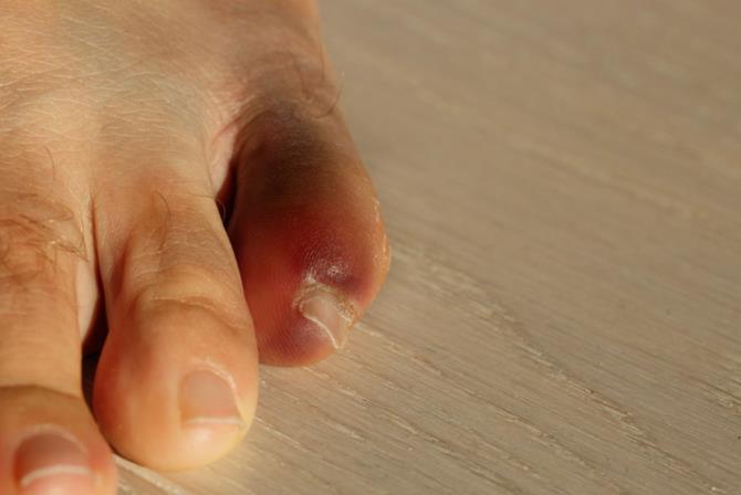 cách chữa ngón chân út bị sưng đau