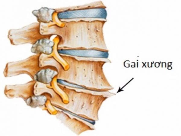 Bệnh lý về xương khớp gây tình trạng đau lưng khi có kinh