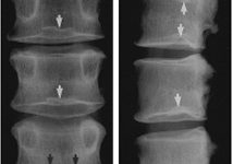 Chuẩn đoán X quang thoái hoá cột sống thắt lưng