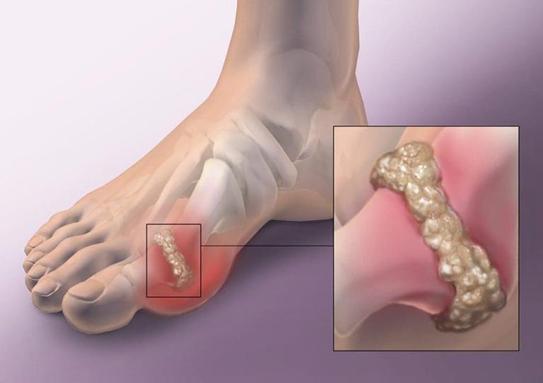 triệu chứng viêm bao hoạt dịch ngón chân cái