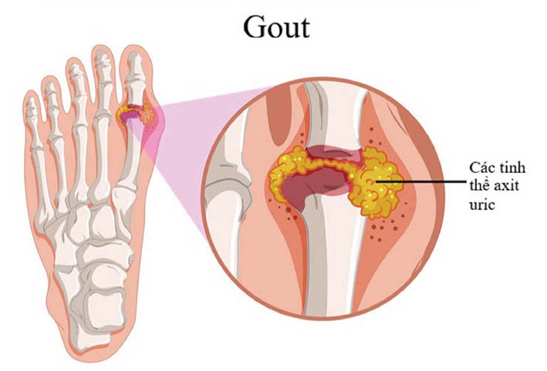 bệnh gout