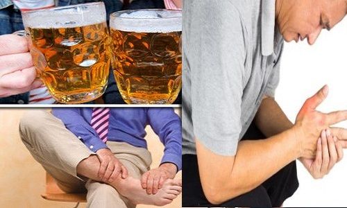 đau nhức xương khớp sau khi uống rượu có nguy hiểm không 